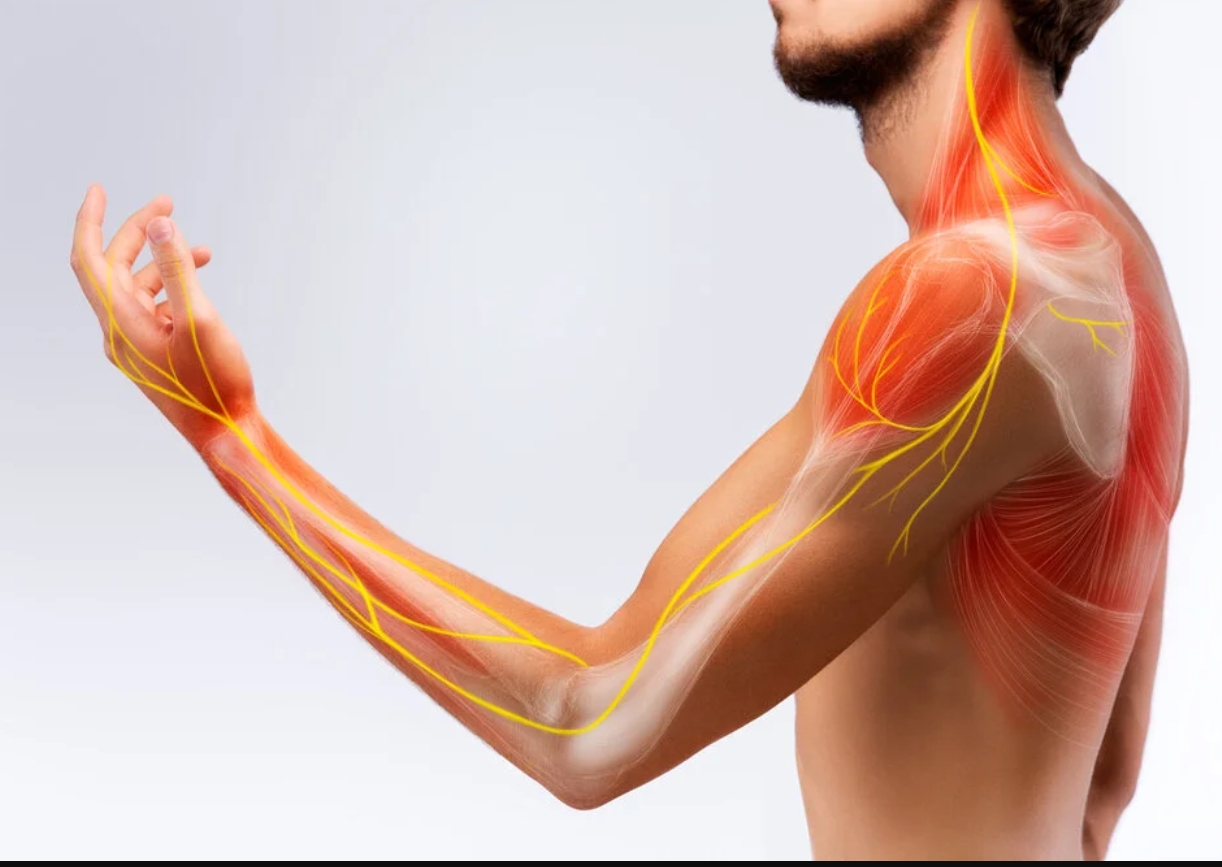 Illustration of nerve pathways in the arm and shoulder highlighting numbness, burning, and tingling