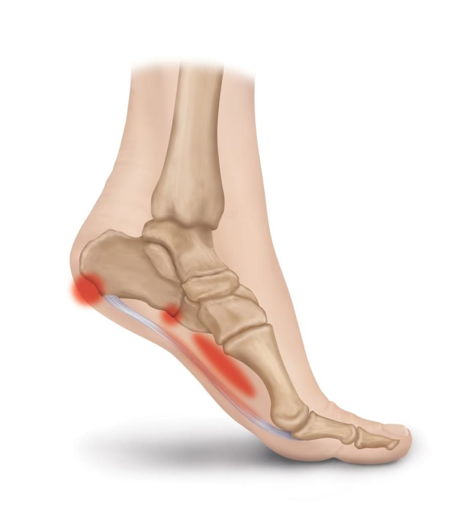 Medical illustration highlighting heel pain from plantar fasciitis