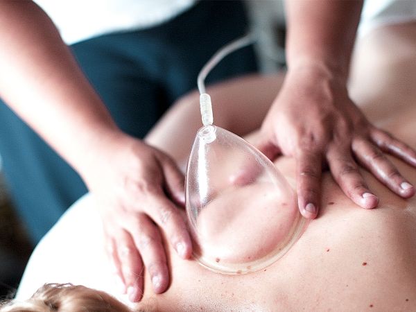 Therapist applying a vacuum cupping cup to a client's back during treatment